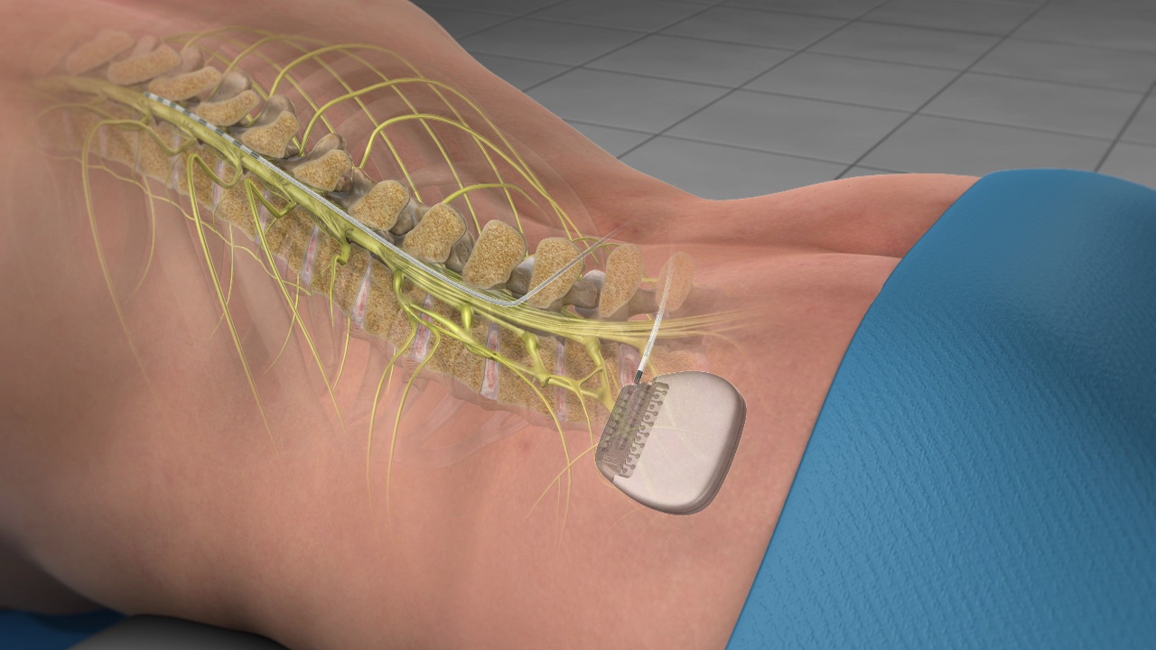 Spinal Cord Stimulator (SCS) Implant